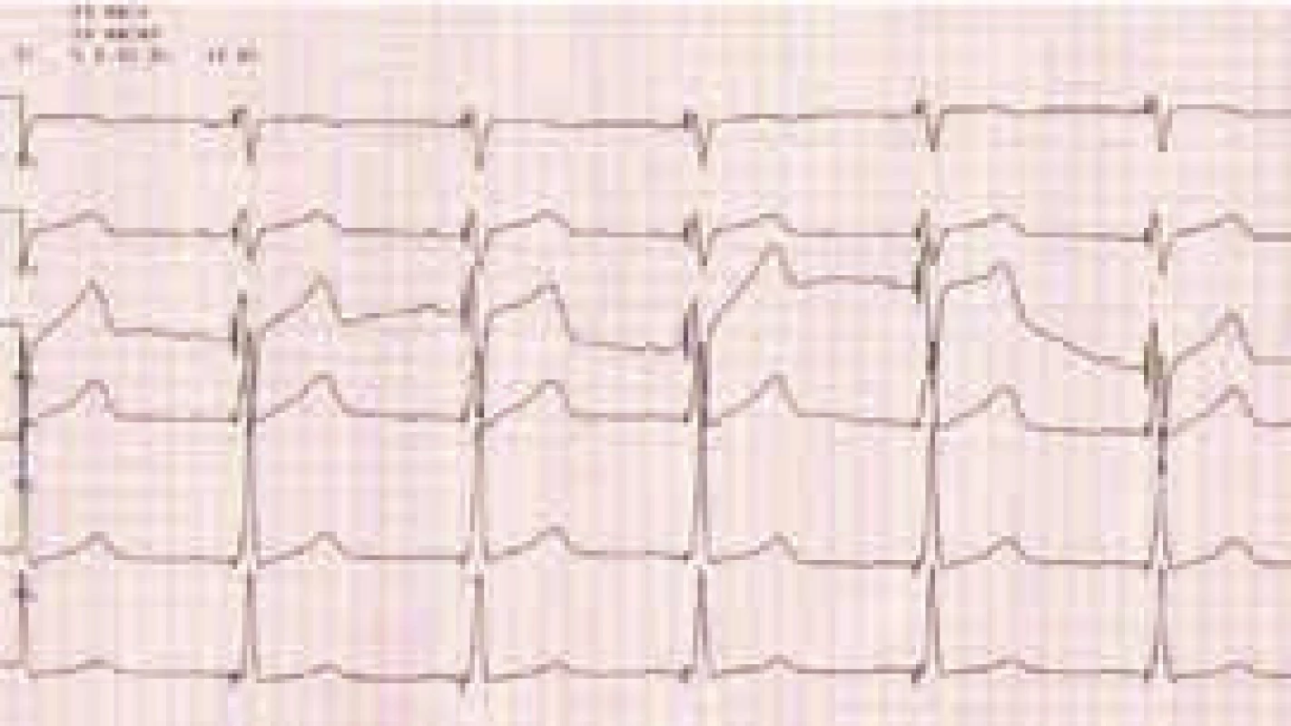 EKG po implantácií CRT u pacienta, ktorého QRS komplex mal predimplantačne morfológiu BĽTR (rovnaký pacient ako na obr. 1). QRS má šírku 100 ms, prítomný R kmit vo zvode V1 s redukciou S kmitu (materiál Kliniky kardiológie LF UPJŠ a VÚSCH a.s., Košice)