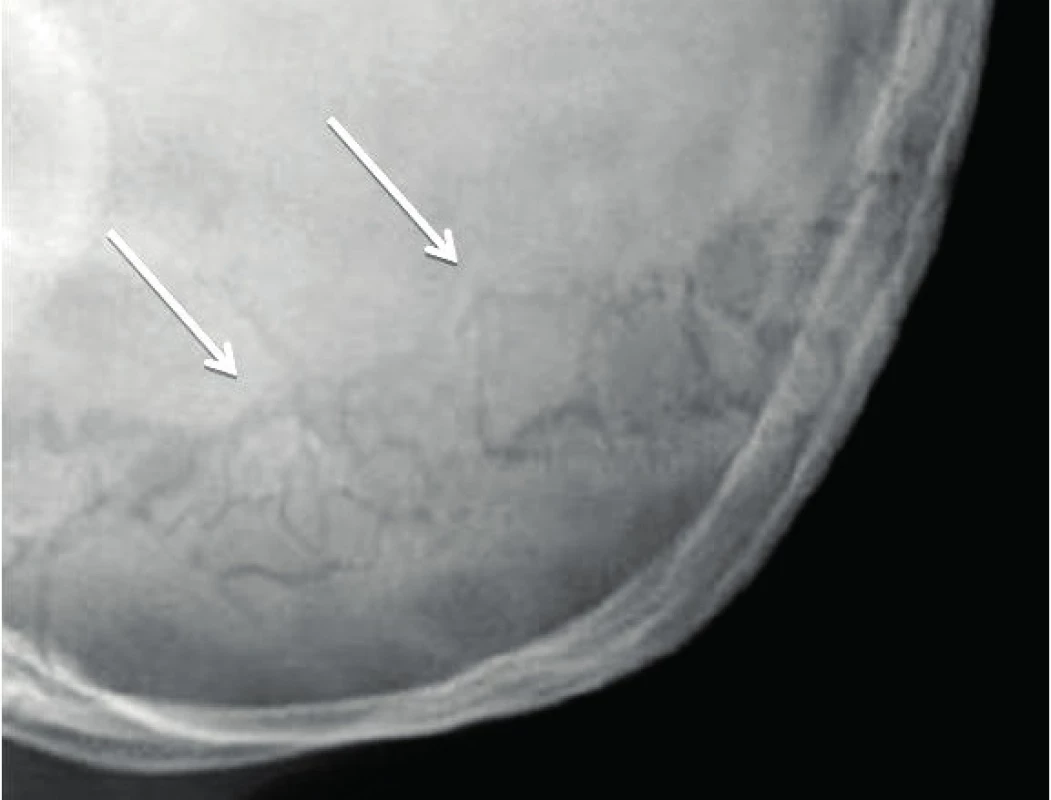 Wormiánské kůstky na snímku lbi.
Fig. 2. Wormian bones on skull X-ray picture.