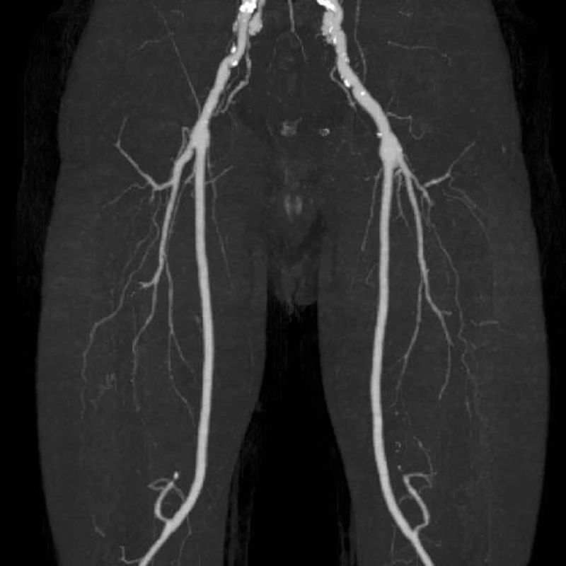 CT AG dolních končetin po půl roce od infektu FP bypassu
Fig. 5: CT angiogram of the lower limbs after 6 months following femoropopliteal bypass infection