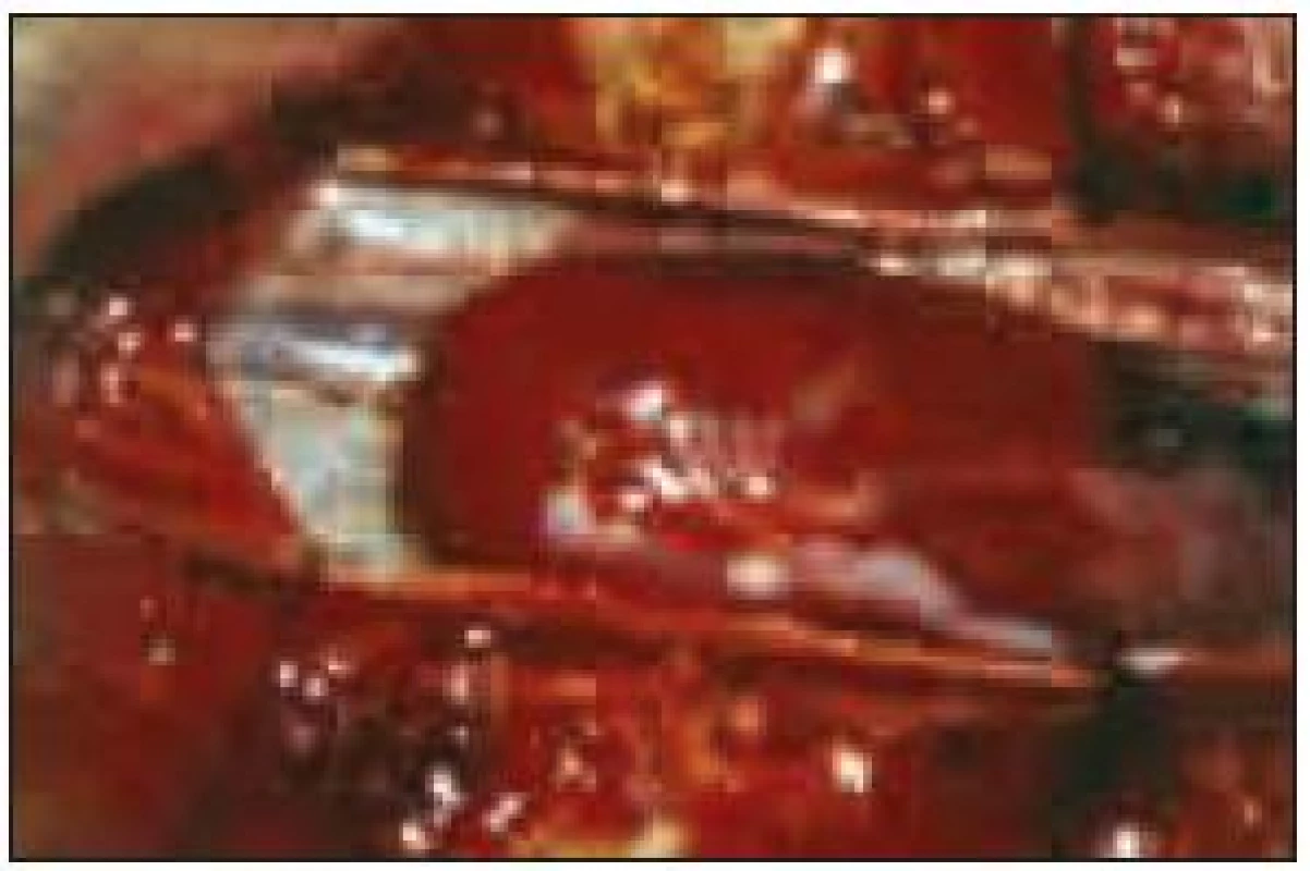 Peroperační foto – tumor.