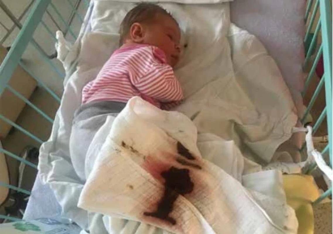 Masívna hemateméza u novorodenca (z archívu Neonatologickej kliniky JLF UK a UNM)