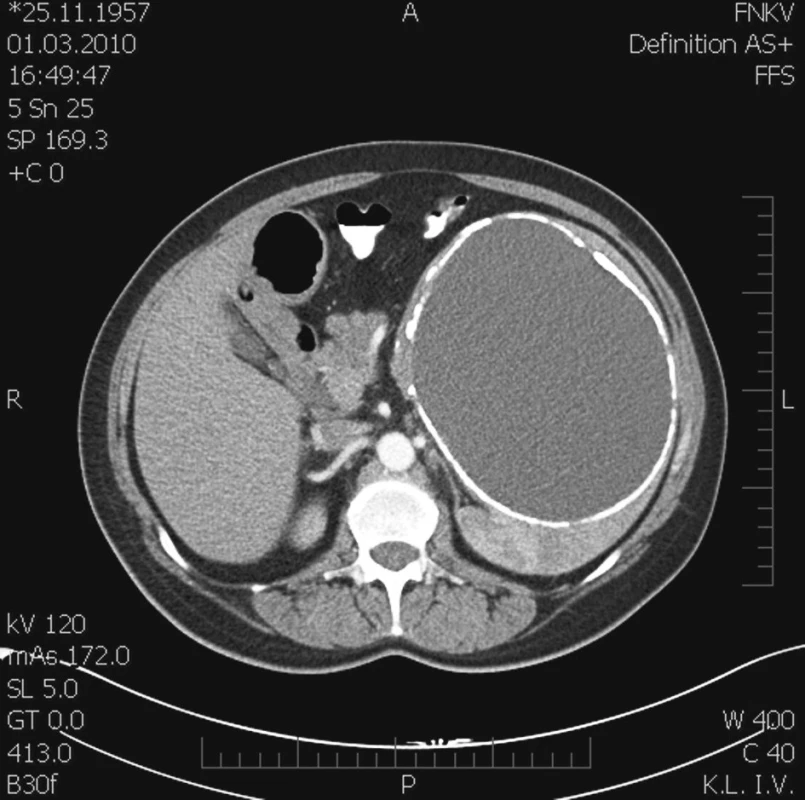 Poúrazová pseudocysta sleziny v CT scanu – transverzální řez
Fig. 1. Post-traumatic pseudocyst of the spleen on CT scantransverse section