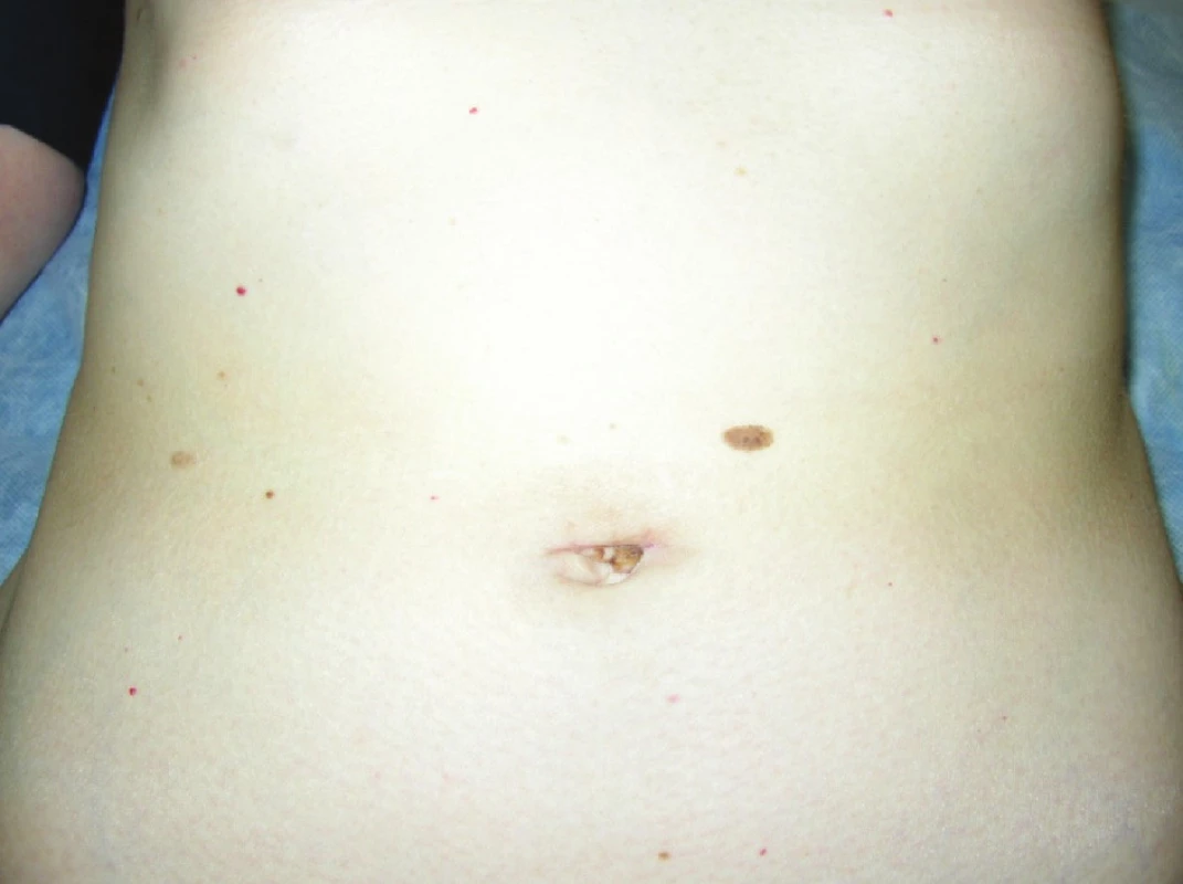 Pacientka po SILS cholecystektómii a apendektómii
Fig. 3. Patient after SILS cholecystectomy and appendectomy