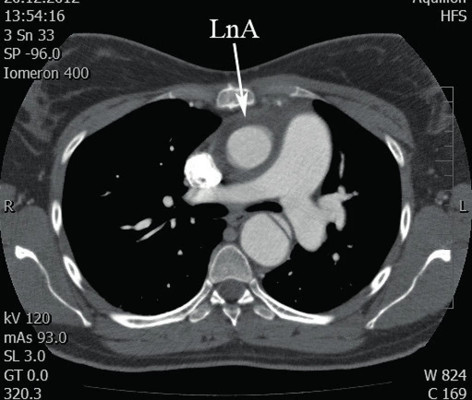 Lem kolem neoaorty (LnA), CT