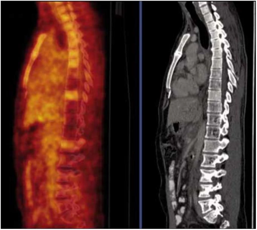 PET-CT vyšetření s podáním i.v. kontrastu provedené v září roku 2010. Jsou patrny četné hemagiomy patrné v obratlech Th (Th<sub>7,8</sub> a Th<sub>10–12</sub>) a LS (L<sub>2</sub>–S<sub>1</sub>) páteře a levé kosti kyčelní, v těchto místech detekujeme sníženou metabolickou aktivitu, která nedosahuje ani fyziologické aktivity v okolních nepostižených obratlech.