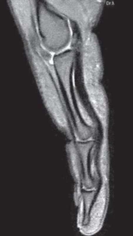 A proximal interphalangeal joint volar plate injury after refi xation of the volar plate.