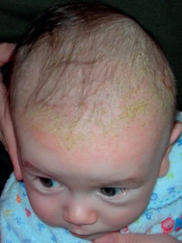  Seboroická dermatitida, chlapec 5 týdnů