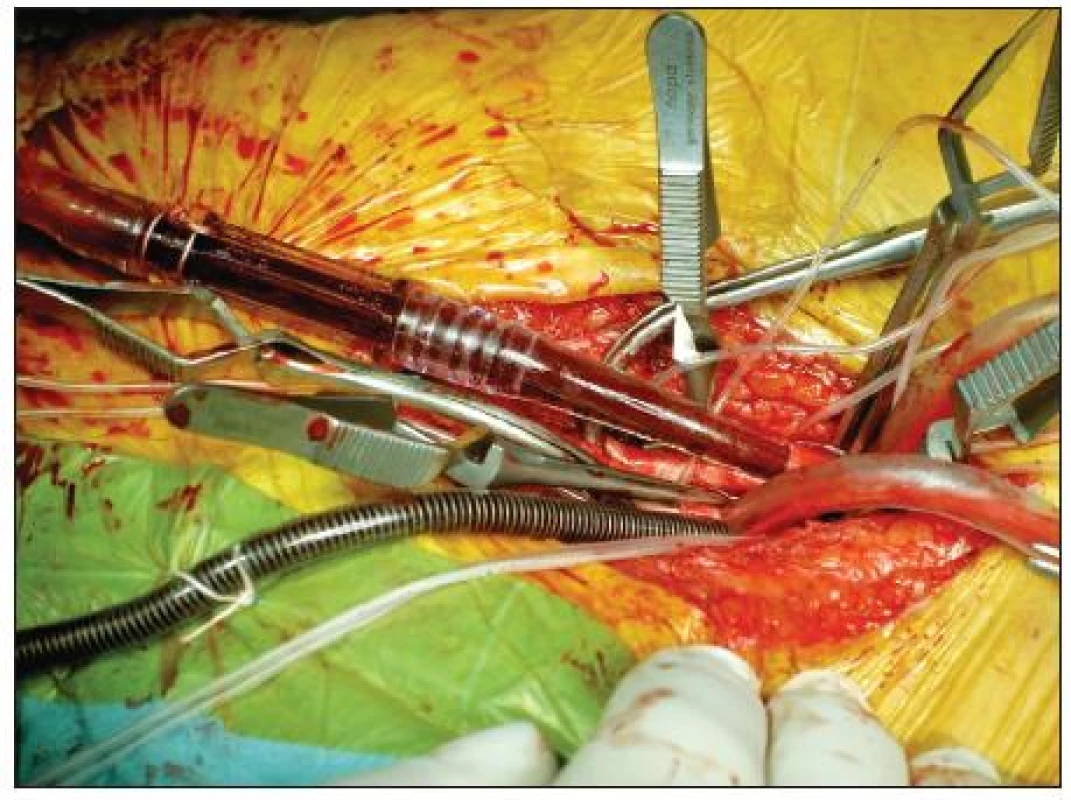 Kanylace femorálních cév pro zahájení mimotělního oběhu. Centrálně jsou cévy uzavřeny pomocí svorek
Fig. 1. Canylation of femoral vessels after initiation of extracorporeal circulation. Centrally, the vessels are closed using vascular clips