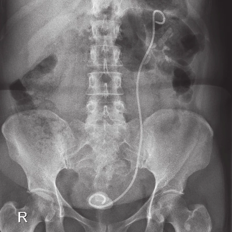 Nefrogram – inkrustovaný proximální i distální konec stentu vlevo a kalikolitiáza ve středním a dolním kalichu vlevo
Fig. 3. Plain-film radiography – incrustation of proximal and distal part of the stent on the left side and calicolithiasis in the middle and lower calyx