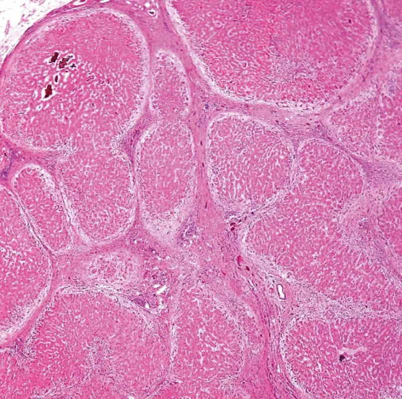 Biliární cirhóza. Světlé periseptální lemy při vystupňované stáze cholátů. Barveno hematoxylinem eozinem (zvětšení 40x).