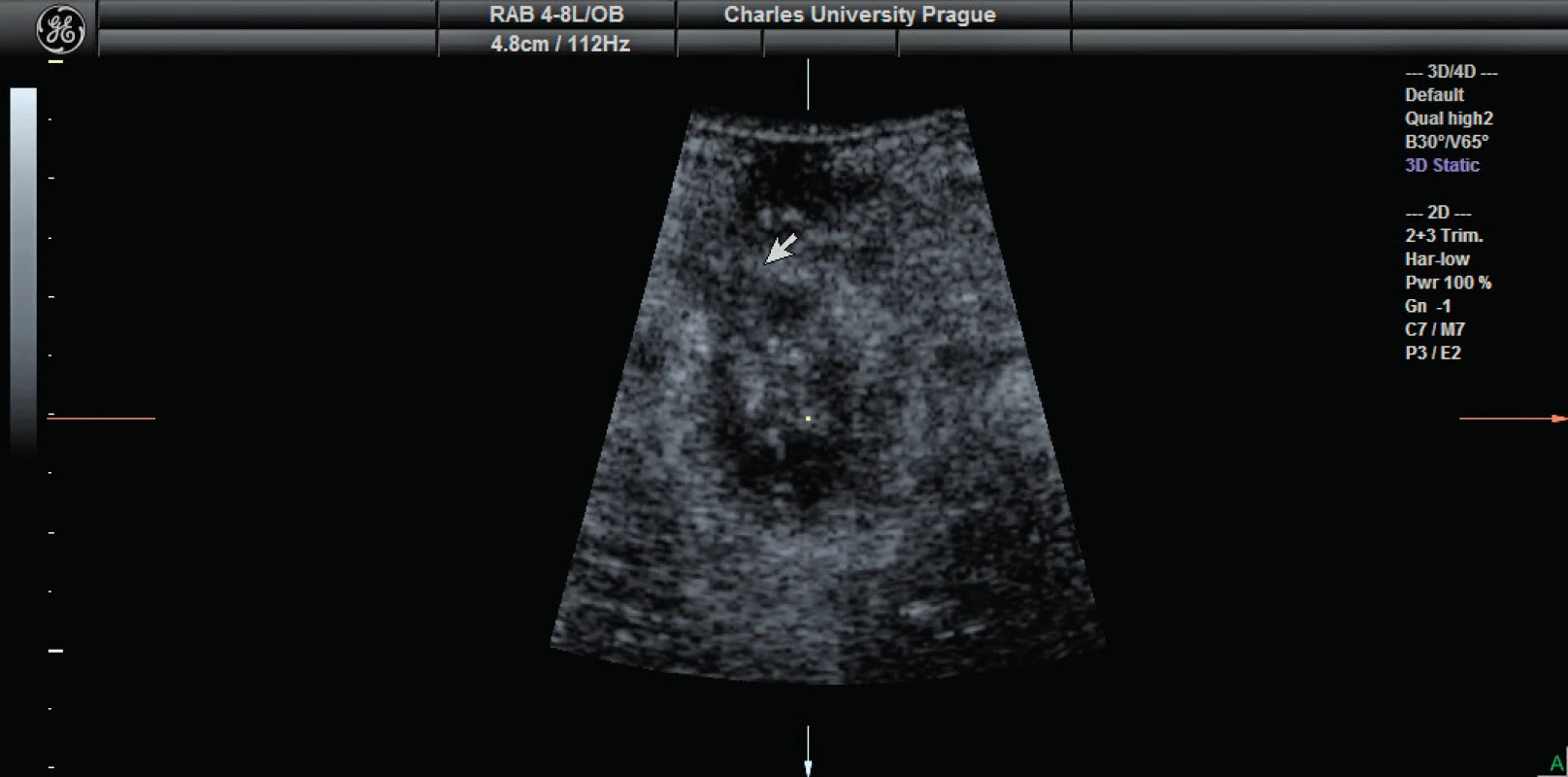 Sutura m. sphincter ani externus – detekce sutury (šipka) m. sphincter ani externus v axiálním řezu z perineálního přístupu