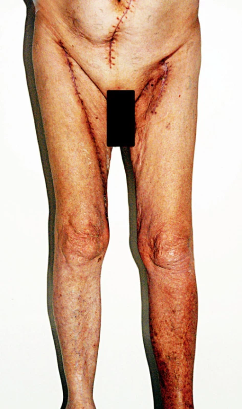 Všechny operační rány se zhojily per primam. Není přítomen edém na pravé dolní končetině po odběru hluboké žíly
Fig. 5. All surgical wounds healed by first intention. The right lower extremity following deep vein harvest is free from oedema