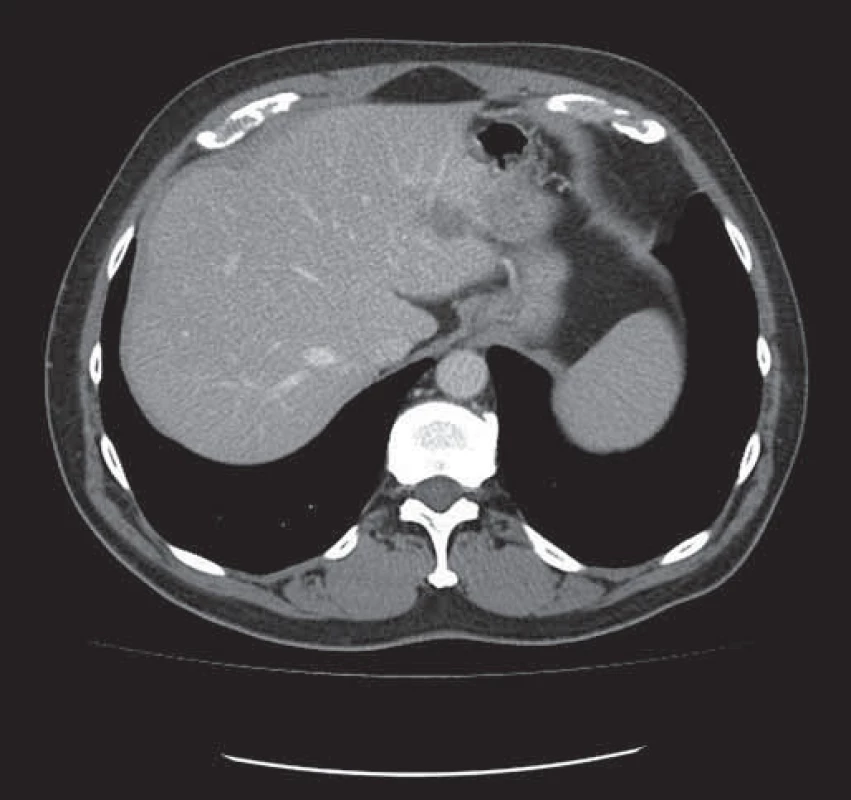 Tatáž metastáza v levém laloku jater zmenšena po neoadjuvantní léčbě chemobioterapií.