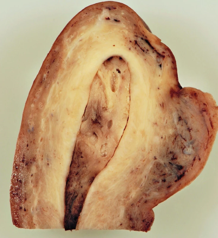 Průřez preparátem dělohy – solitární fibrózní tumor zcela vyplňuje děložní dutinu a věrně napodobuje běžný korporální polyp endometria