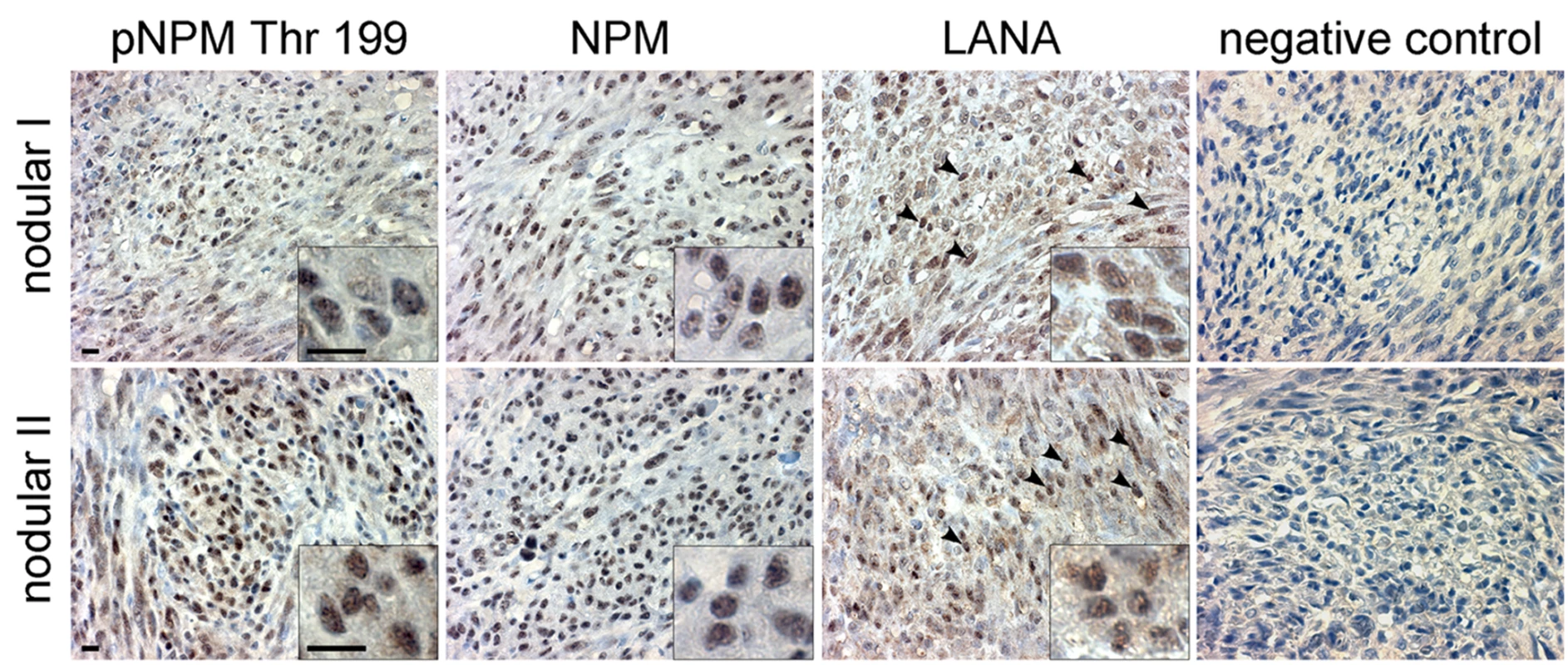 KS tumors express NPM phosphorylated on Thr199.