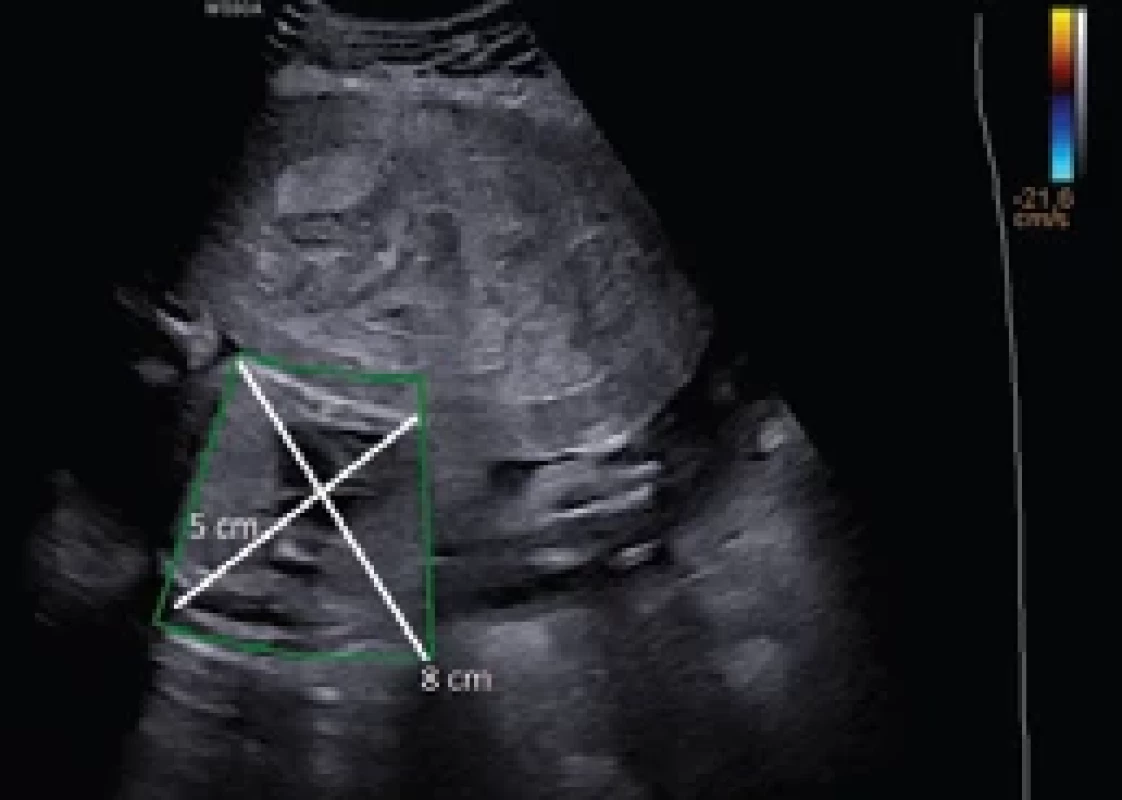 Transabdominal ultrasound performed with a Hera WS80A apparatus (Samsung Corp., Seoul, South Korea): the green ROI (region of interest) shows a retroplacental hematoma measuring 8 × 5 cm. </br>Obr. 2. Transabdominální ultrazvuk provedený na přístroji Hera WS80A (Samsung Corp., Soul, Jižní Korea): zelená ROI (oblast zájmu) ukazuje retroplacentární hematom o rozměrech 8 × 5 cm.