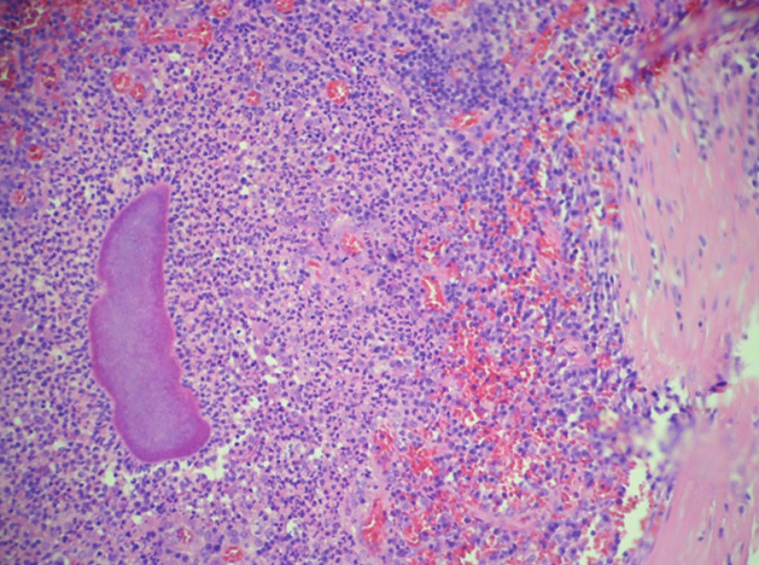 Ovarium - charakteristická drúza v zánětlivém infiltrátu
Fig. 6: The ovary – characteristic sulfur granule in inflammatory infiltration