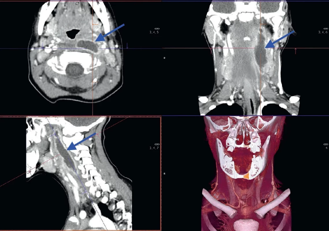 Retrofaryngeální absces, CT s kontrastní látkou ve třech projekcích a 3D rekonstrukce.