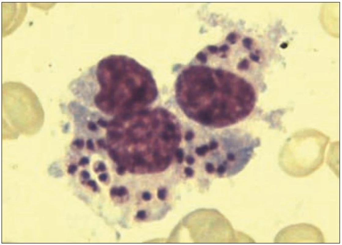 Amastigoty <em>Leishmania sp.</em> fagocytované makrofágem v kostní dřeni (barvení dle Pappenheima, zvětšeno 1 000krát).