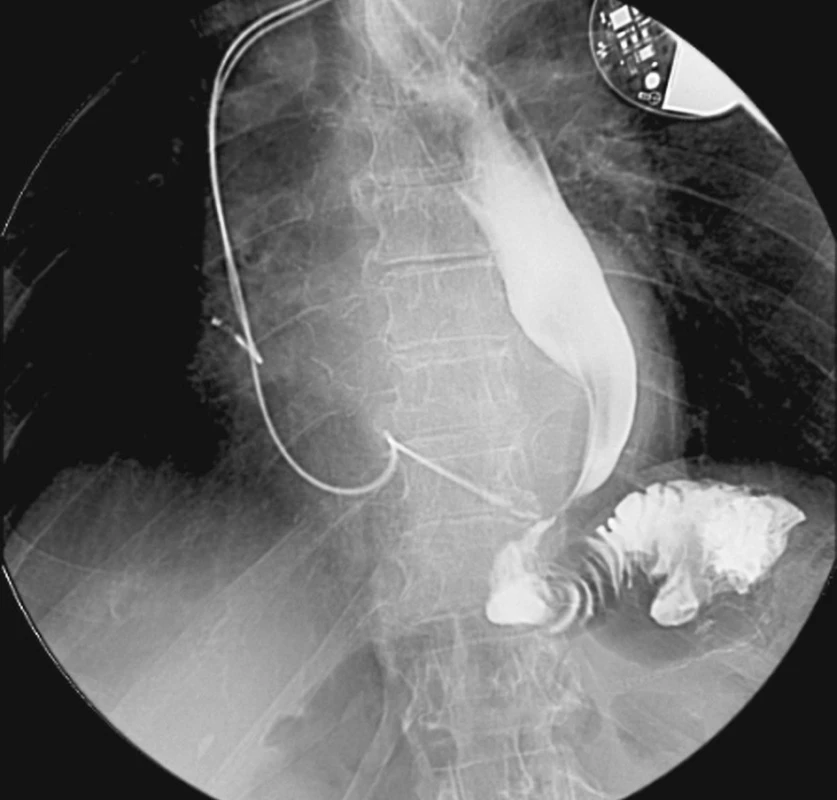Striktura v ezofagojejunoanastomóze po totální gastrektomii
Fig. 4. Esophagojejunal stricture following total gastrectomy
