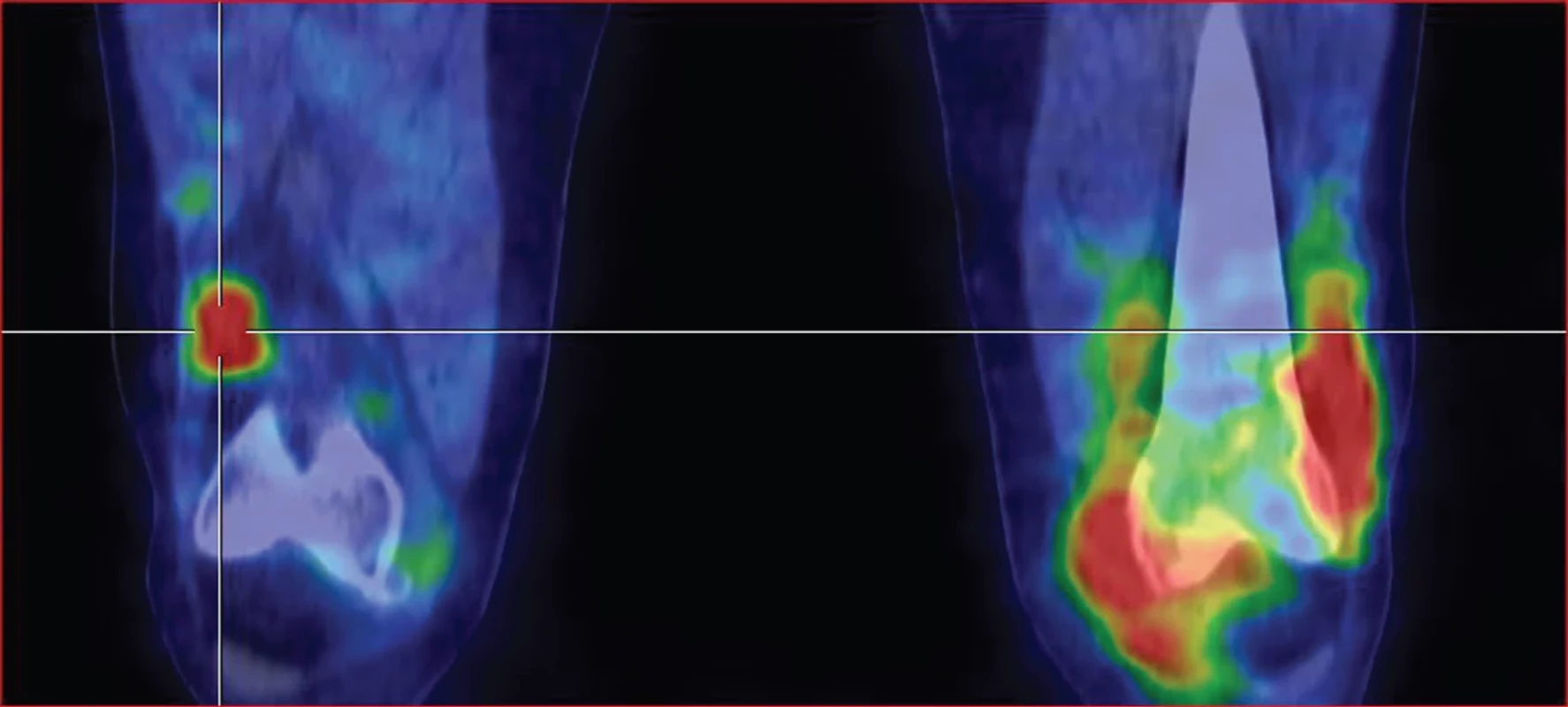 SPECT/CT kolenních kloubů v časné fázi v koronárním řezu – vpravo zvýšený krevní pool v oblasti odpovídající suprapatelární burze, vlevo výrazně zvýšený krevní pool v oblasti synoviální membrány levého kolenního kloubu (při avaskulární nekróze – AVN).