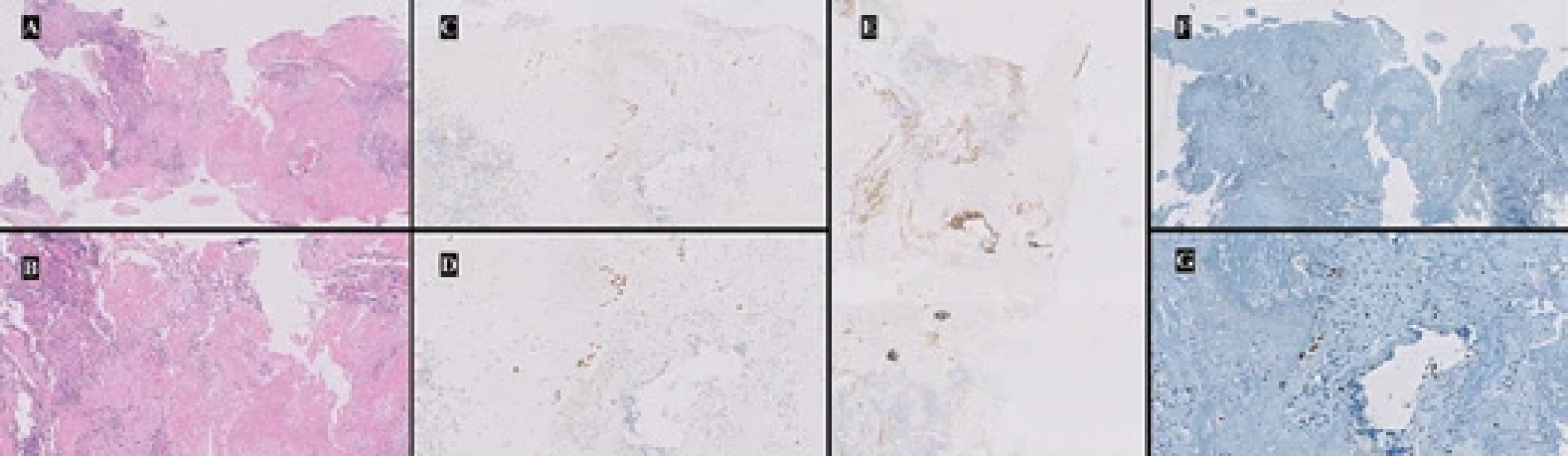 Histopathological evaluation of the endometrial biopsy specimen. A, B) Circumscribed, hyalinized aggregate of intermediate trophoblasts with central hyalinization, arranged in cohesive nests and cords exhibiting cytologic and mild nuclear atypia, at 10× and 20× magnifi cation, respectively (hematoxylin-eosin stain). C. D) Immunostaining for p63 showing positive nuclear staining in epithelioid cells, at 10× and 20× magnifi cation, respectively (clone kp10/SP 118, 1 : 400 dilution, Dako® Corporation, Capinteria, CA, USA. Isotope: IgG; Antigenic reactivation: citrate pH 6.0; Overnight incubation 6 °C). E) Positive immunostaining for placental alkaline phosphatase in epithelioid cells, at 10× magnifi cation. F, G) Ki-67 immunostaining showing a proliferation index > 5%, (clone BC4A4, 1 : 900 dilution, Dako® Corporation, Capinteria, CA, USA. Isotope: IgG; Antigenic reactivation: citrate pH 6.0; Overnight incubation 6 °C) at 10× and 20× magnifi cation, respectively.