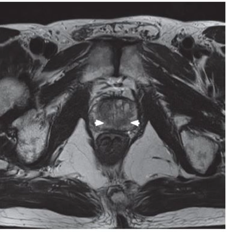 T2 vážené zobrazení – hypointenzivní ložiska tumoru (bílé šipky)
Fig. 1. Hypo-intense tumor regions of the both lobes of the prostate (white arrows) in T2 weighted MRI