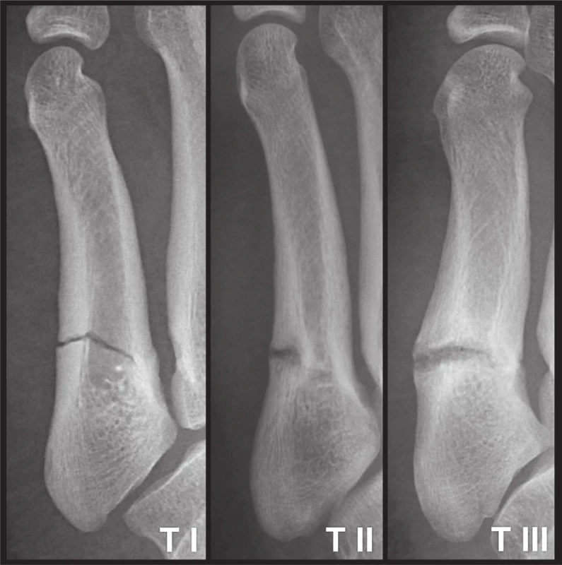 Klasifikace únavových zlomenin podle Torga [12]
Typ I – early; Typ II – delayed union; Typ III – nonunion.
Fig. 3: Torg’s classification of stress fractures [12]
Type I – early; Type II – delayed union; Type III – non-union