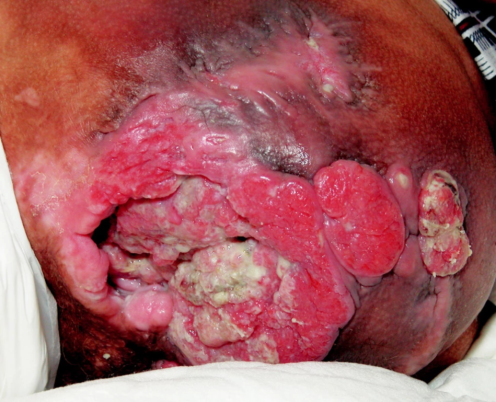 Dekubitus sakrálnej oblasti pri prvom prijatí pacienta na Kliniku plastickej, rekonštrukčnej a estetickej chirurgie.
Fig. 1. Sacral decubitus upon first hospitalization of the patient in the Clinic of Plastic, Reconstructive and Esthetic Surgery.
