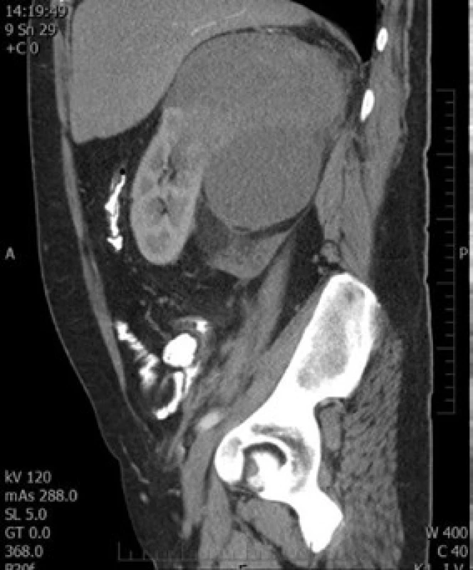 CT snímek tumoru
Fig. 2. CT of tumor