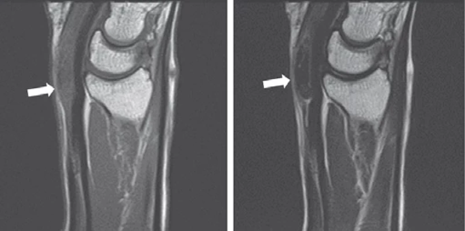 Preoperative MRI. a) T1-weighted image; b) T2-weighed image. The sagittal image of the wrist showed soft tissue mass around the fl exor tendon sheath (white arrow).