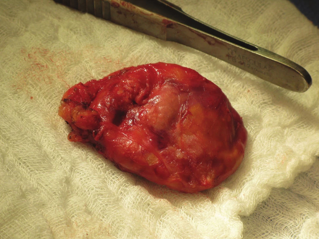 Preparát příštítného adenomu
Fig. 4: Preparation of the parathyroid tumour