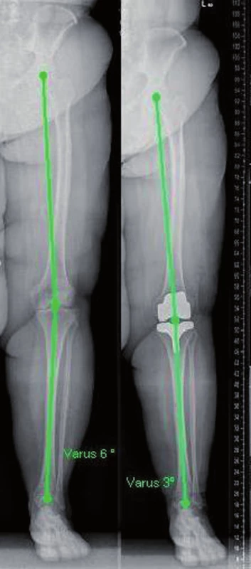 Mechanická osa končetiny před operací a po implantaci endoprotézy – rtg
