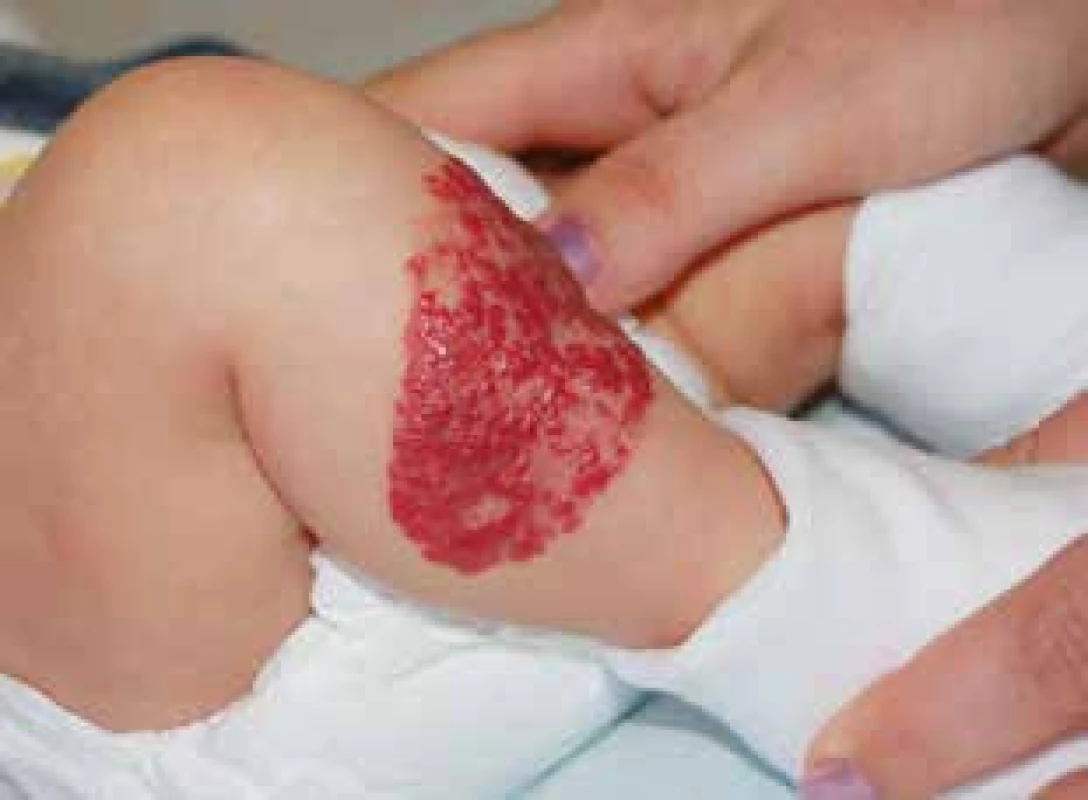 Infantilní hemangiom superficiální.
Fig. 1. Superficial infantile hemangioma.