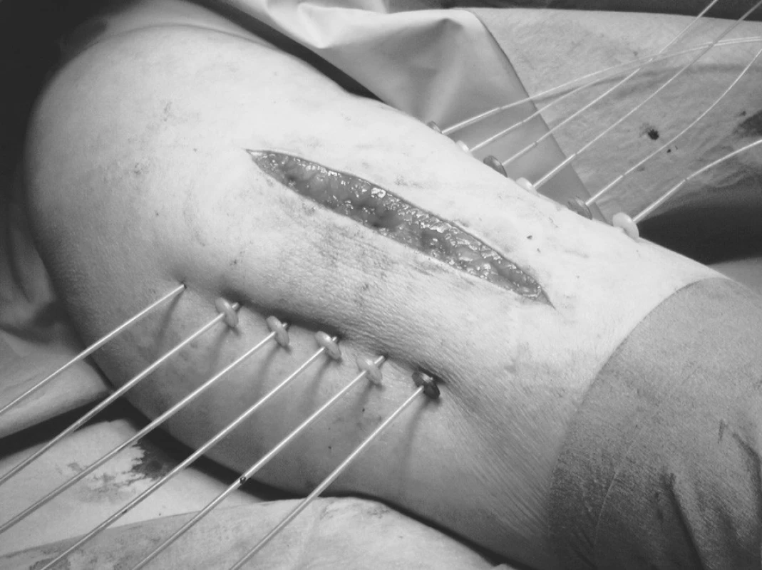 Peroperační intersticiální brachyterapie sarkomu měkkých tkání
Fig. 5. Peroperative interstitial brachytherapy of a soft tissue sarcoma