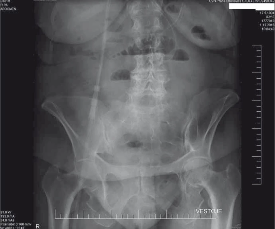 RTG nativ břicha před chirurgickou revizí.
Fig. 1. X-ray image of abdomen without contrast agent before surgical revision.