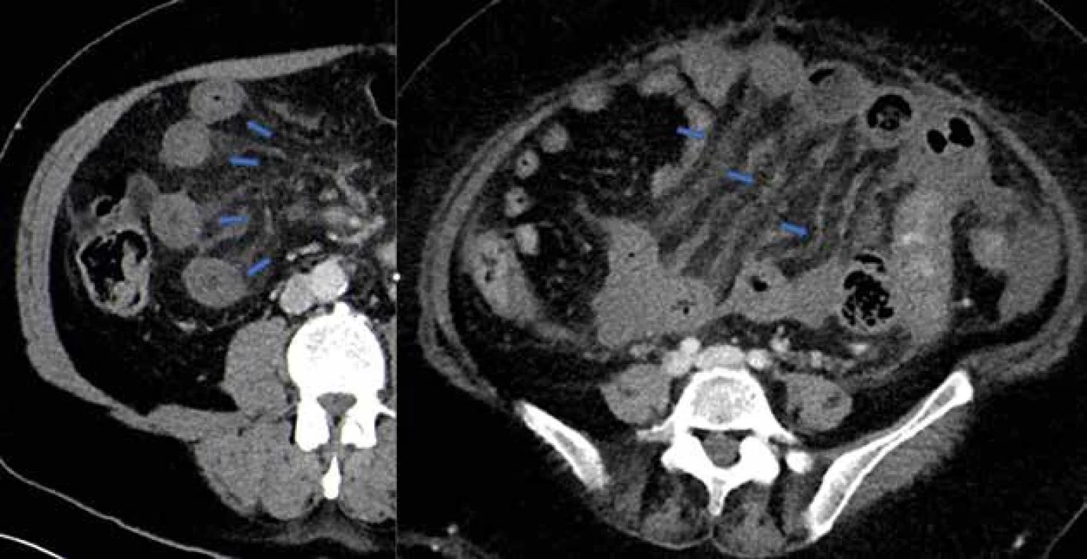 Zhrubnutie čreva a mezentéria – MVT   Fig. 4: Thickening of the intestine and mesentery – MVT