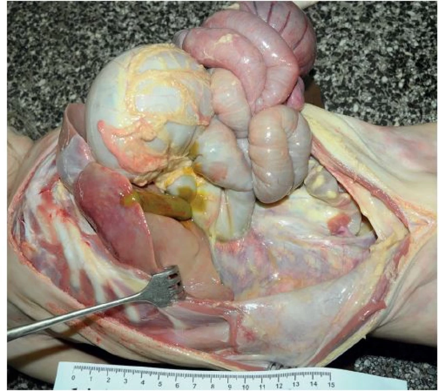 Nález v dutině břišní u 2,5leté dívky. Segmentální volvulus tenkého střeva s hemoragickou infarzací střevní stěny v postiženém úseku. Ani v tomto případě není přítomen obvyklý široký úpon mezenteria k zadní stěně dutiny břišní. Závěs tenkého střeva je úzký, společný s volným mesocolon vzestupného tračníku – mesenterium commune.