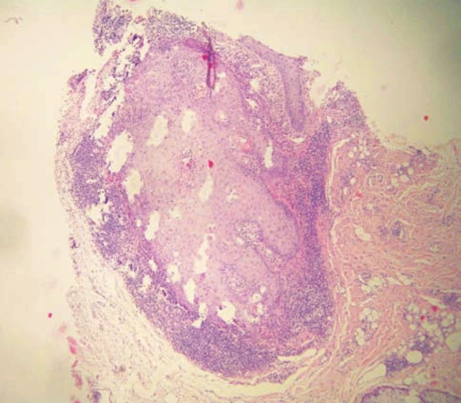 Histologický nález
Vlasový folikul v šikmém řezu má akantotickou stěnu, ke které přiléhá pruhovitý infiltrát lymfocytů (HE, 40x)