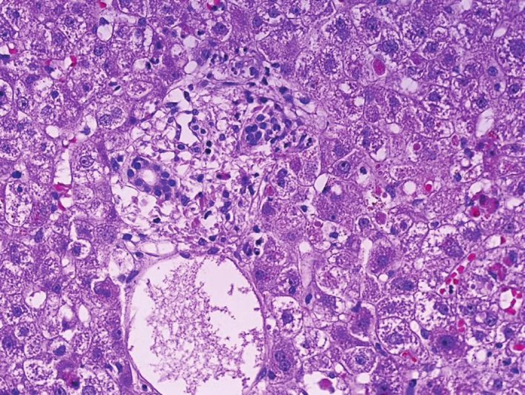 Biopsie jater pro dysfunkci štěpu časně po transplantaci s morfologií četných acidofilních tělísek, edému port. pole s polynukleáry, včetně eozinofilů. Morfologie je dobře kompatibilní s projevy akutní humorální rejekce (HE, objektiv 40x)