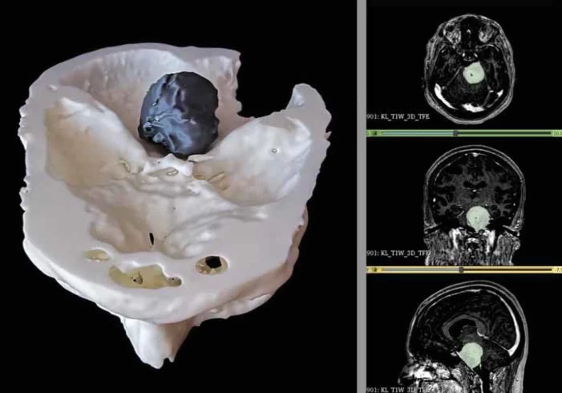 3D modeling of the petroclival meningioma.