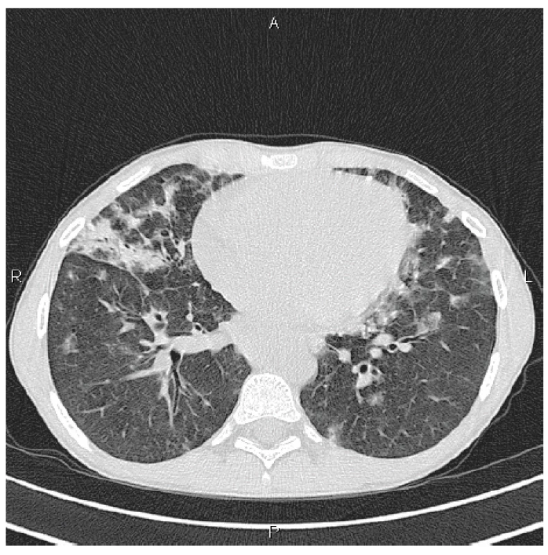 HRCT plic, transverzální sken, plicní okno: bilaterálně
denzity mléčného skla a konsolidace s maximem peribronchiálně,
spíše ventrálně<br>
Figure 1. HRCT of the lungs, transverse scan, lung window:
bilateral ground glass opacifications and consolidations most
pronounced in the peribronchial areas, predominantly in the
ventral areas
