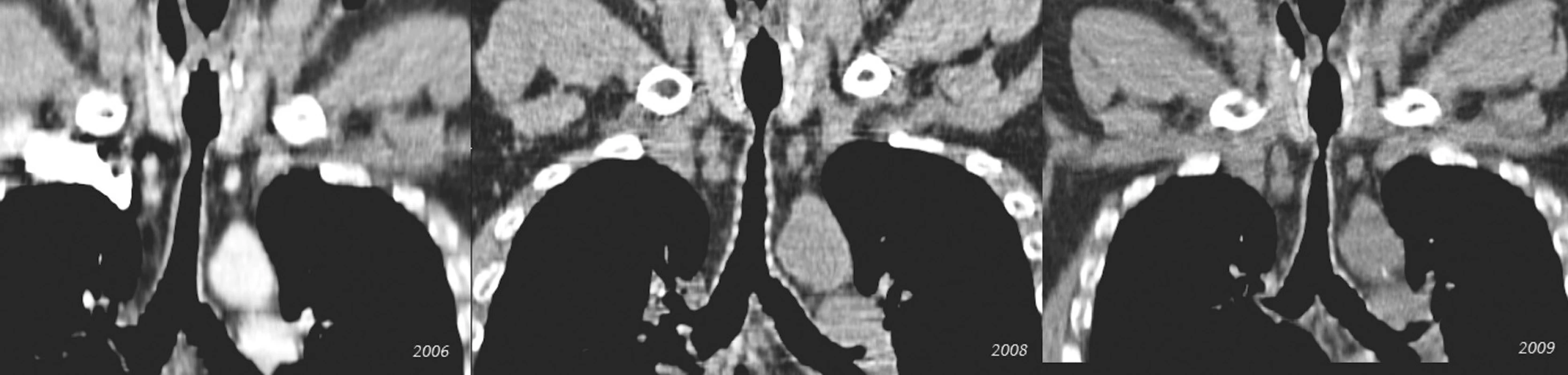 Postupná progresia stenózy v priebehu 4 rokov (pacient č. 5)
Fig. 4. Gradual progression of the stenosis during a 4-year period (patient No 5)