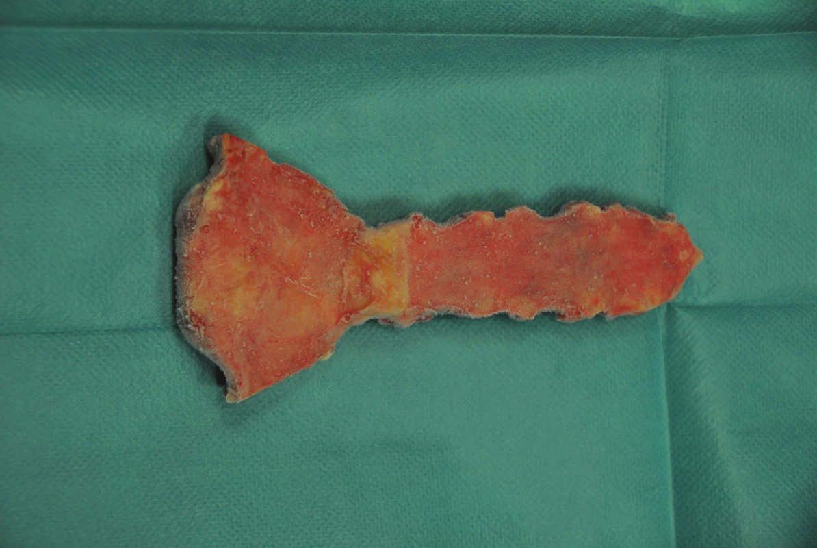 Allogenní kostní štěp sterna před transplantací
Fig. 1: Allogeneic bone graft of the sternum before surgery