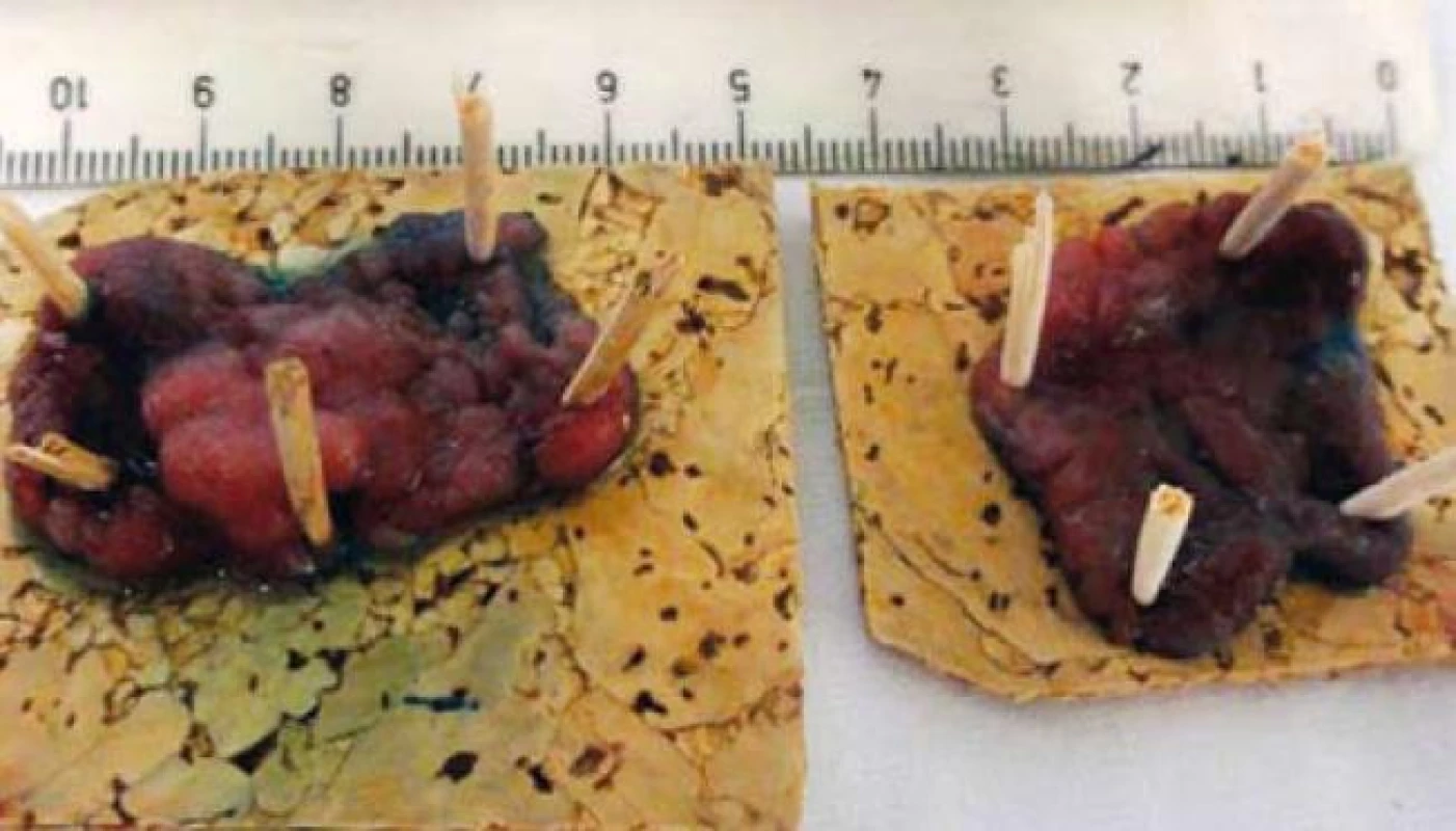Fixace podstatných částí resekátu.
Fig. 5. Fixation of substantial parts of resected specimen.