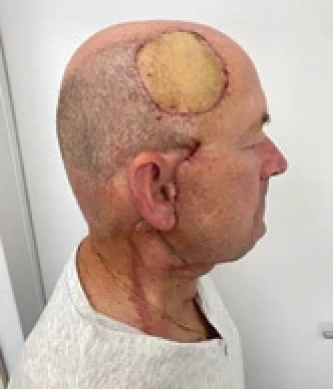 Reconstruction of a frontoparieto- temporal defect with the radial forearm free fl ap.