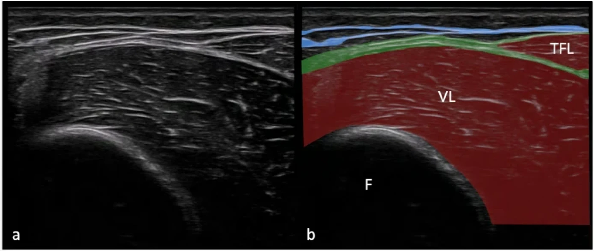  Zobrazení fascia lata v lokalizaci lateral na nativním sonografickém snímku (a) a na barevně zvýrazněném sonografickém snímku (b). Superficiální fascie je znázorněna modrou linií. Hluboká fascie (zelená linie) přechází přes VL. Fig. 7. Imaging of the fascia lata in the ateral location in the original ultrasound image (a) and in a color-enhanced ultrasound image (b). The superficial fascia is represented by a blue line. The deep fascia is represented by a green line over the VL. 