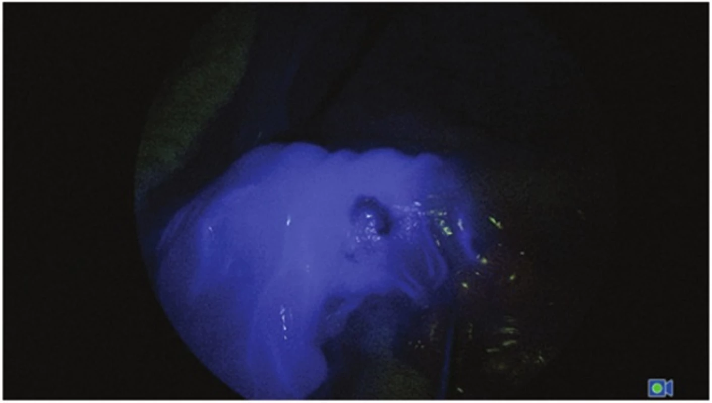 Střevní segment po aplikaci ICG (modrá – tkáň s optimální perfuzí)
Fig. 2: Bowel segment after ICG aplication (blue – tissue with optimal perfusion)