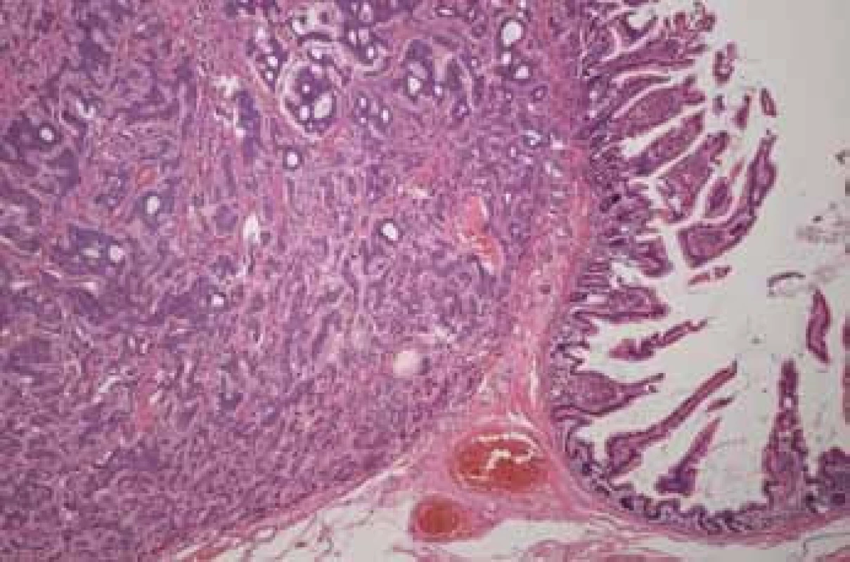 Histologický nález: karcinoid – barvení hematoxylin-eozin (Fingerlandův ústav patologie, Fn Hradec Králové).
Fig. 4. Histological investigation: karcinoid – hematoxylin-eosin staining (The Fingerland Department of Pathology, Faculty hospital Hradec Kralove).