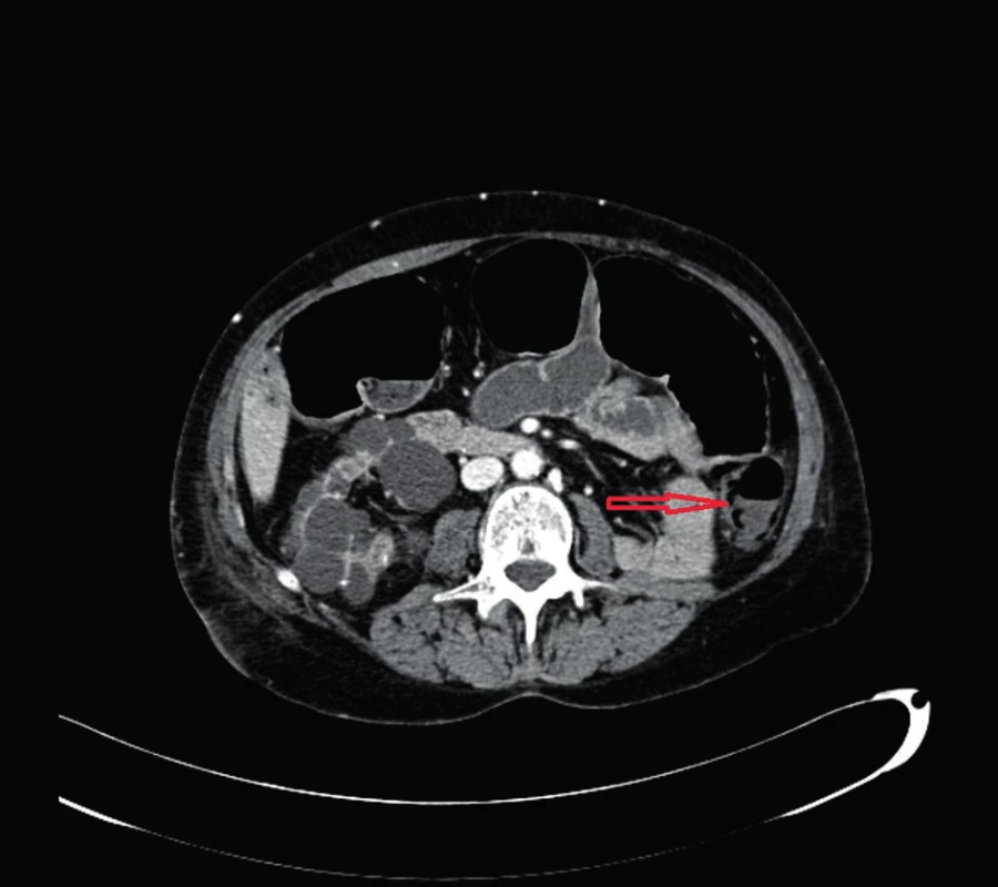 Pneumatoza steny colon descendens
Fig. 2: Pneumatosis of the wall of the descending colon